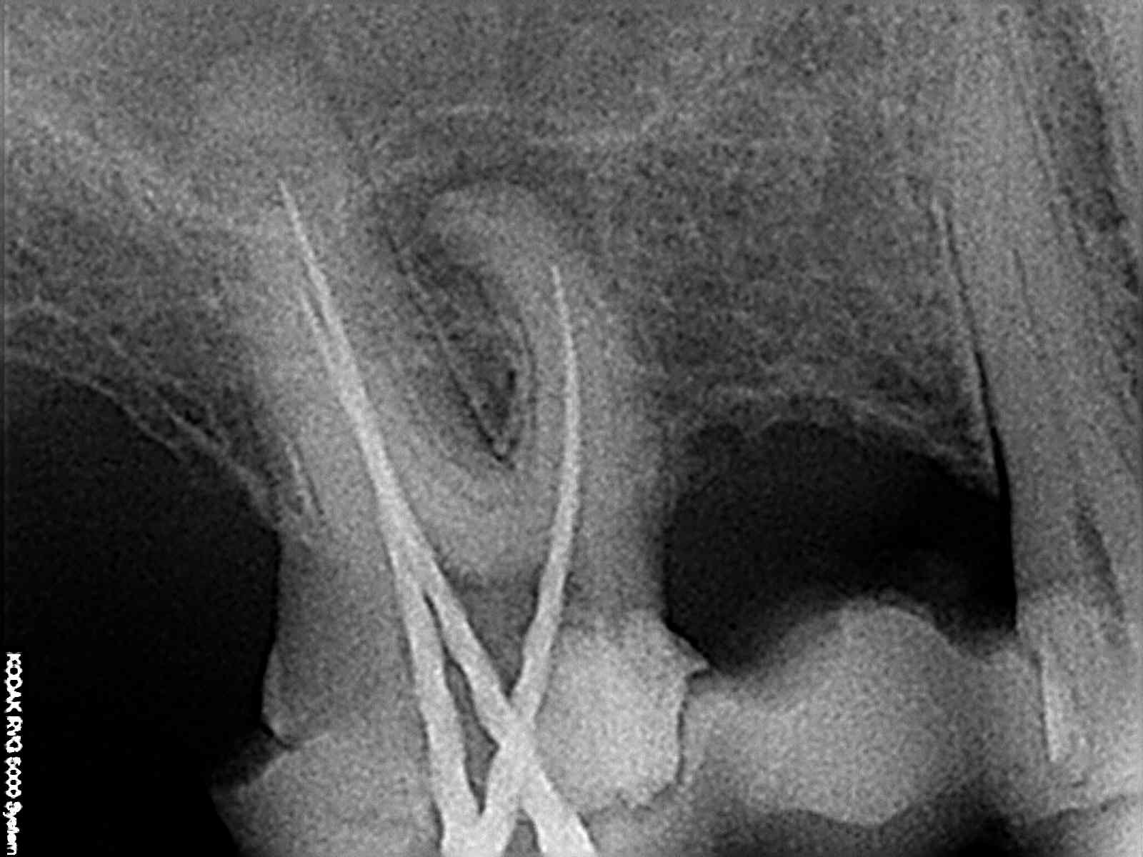 root canal treatment
